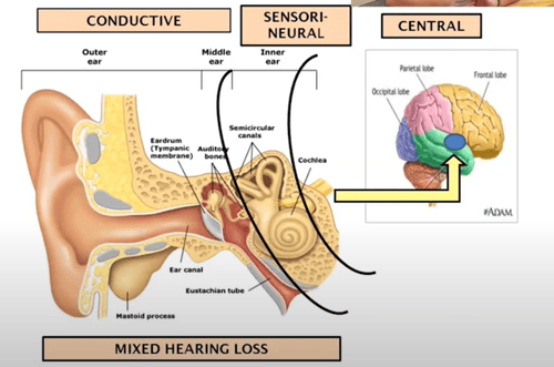 3 types of hearing loss