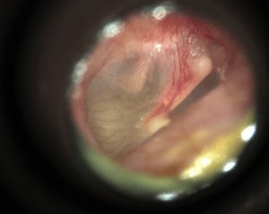 A view of the ear drum