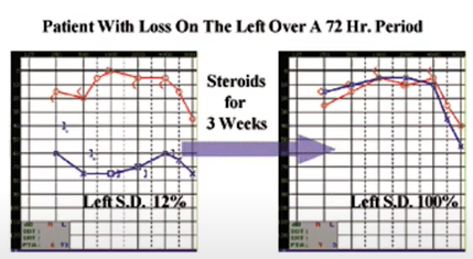 SSD treatment with steroids hearing recovery